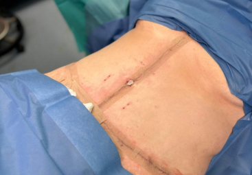 Abdominoplastie et lipœdème : l’expérience de Lyn