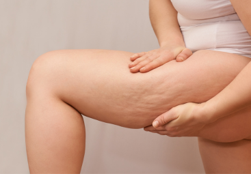 Causes de la cellulite : pourquoi est-elle si fréquente ?